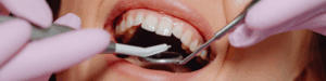 Implantes dentales en Gijón