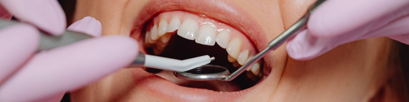 Implantes dentales en Gijón