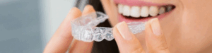 Carillas dentales