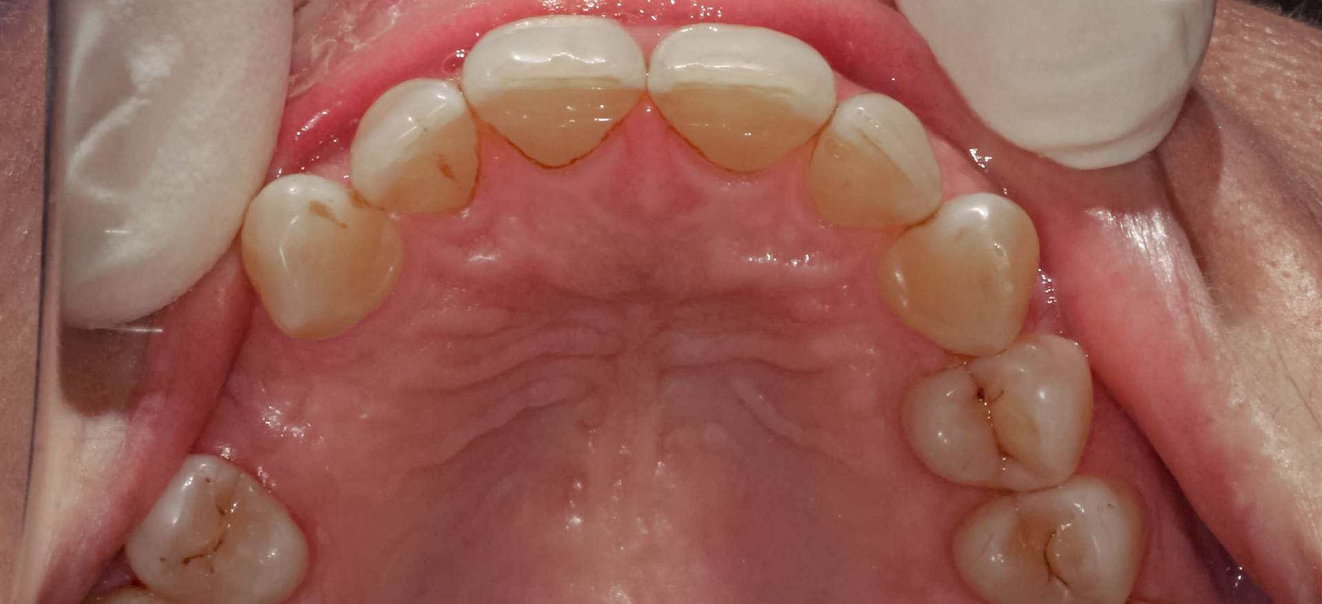 implante-unitario-1 implante-unitario-1