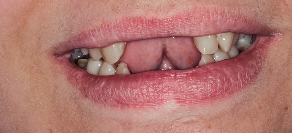 implantes-multiples-1 implantes-multiples-1