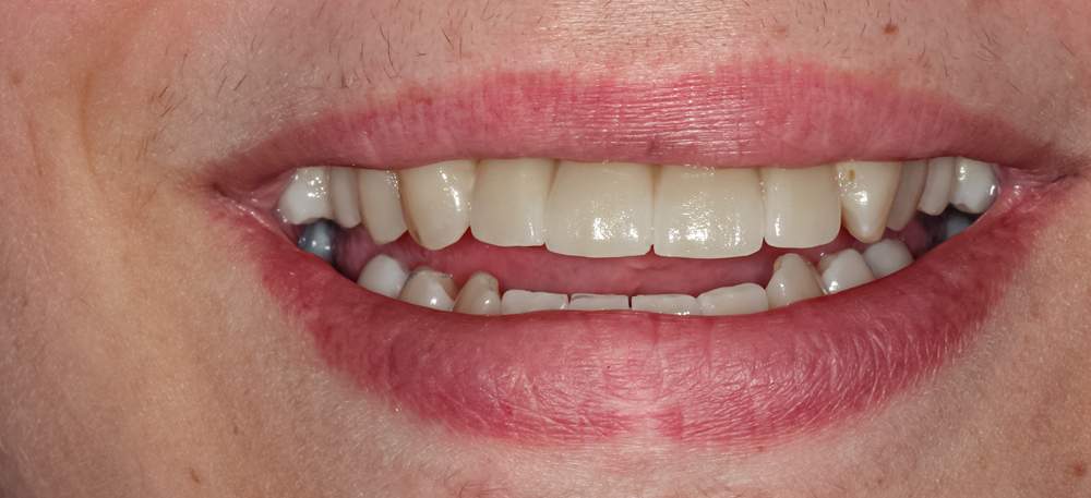 implantes-multiples-2