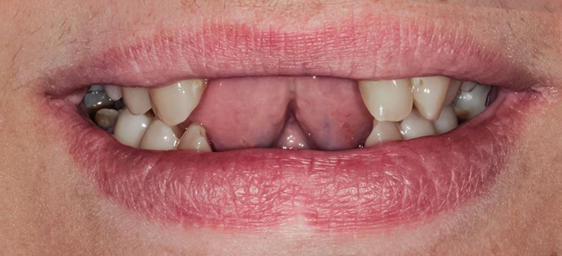 implantes-multiples-1