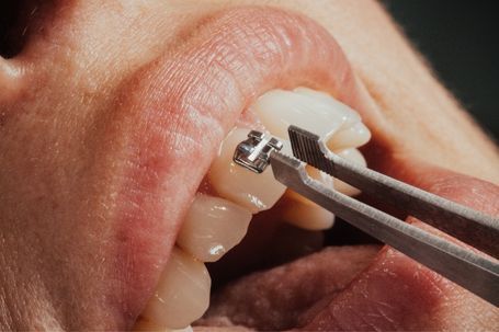 Colocación de brackets en tratamiento de ortodoncia infantil en Gijón para corregir la alineación dental.