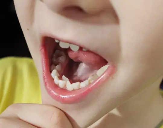 Niño mostrando apiñamiento dental durante una revisión de ortodoncia infantil en Gijón.