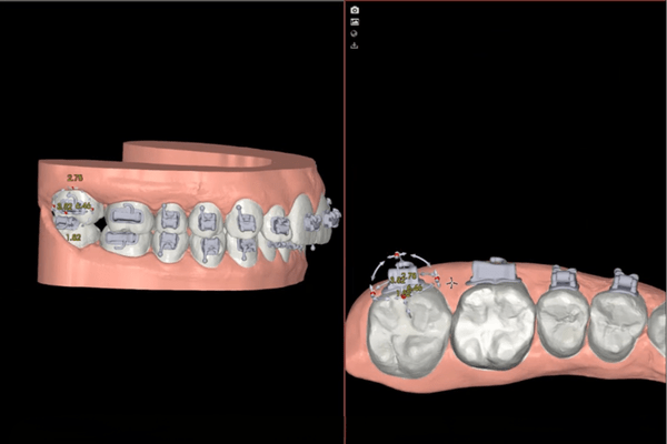 brackets-baratos-en-gijon