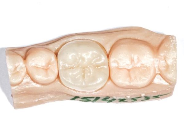 colocacion-de-la-restauracion